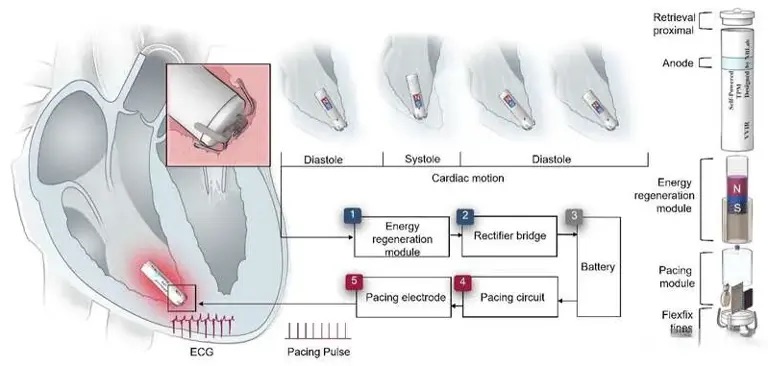 我国科研团队成功研制全球首款心跳自供电微型心脏起搏器