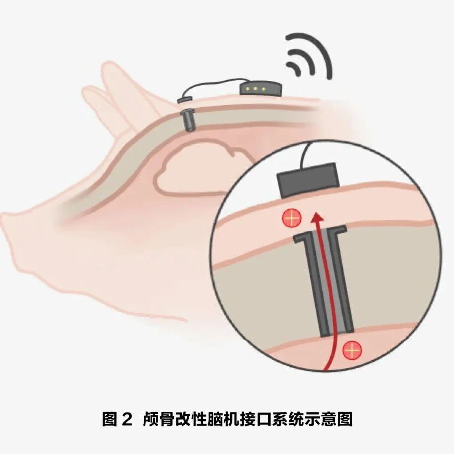 脑机接口新突破：颅骨微创电改性技术