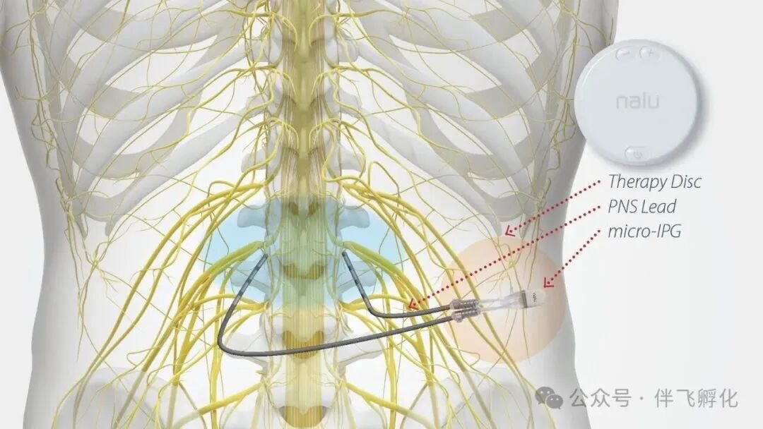 5.33亿美元！波士顿科学收购神经调控公司Nalu Medical，加速布局慢性疼痛管理图3