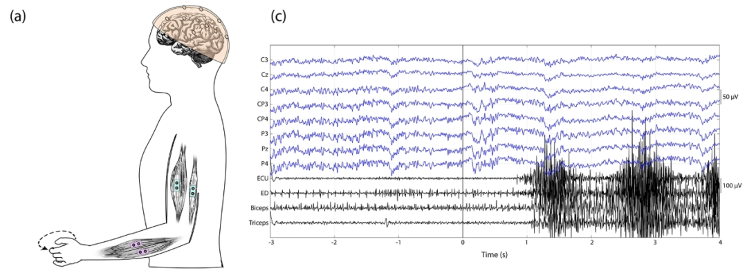 脑机接口技术新信息| 脑电+肌电神经接口协同助力慢性脑卒中患者神经康复