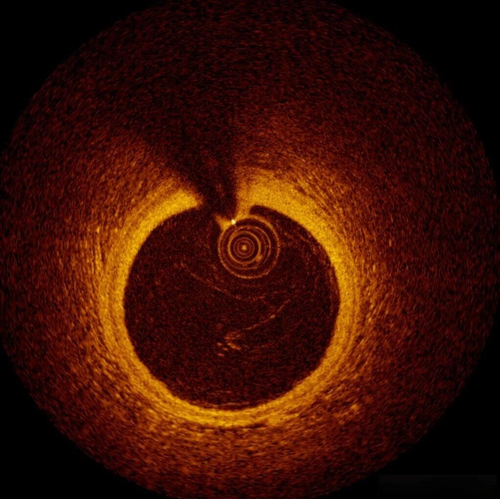 临床PK完胜ChatGPT-5！国内团队造出首个OCT影像AI系统