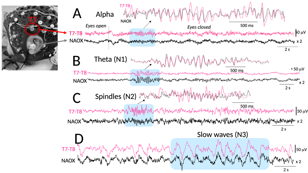 前沿 |&nbsp;新型耳后脑机接口贴片问世，北理工团队推出可穿戴脑机接口新方案图1