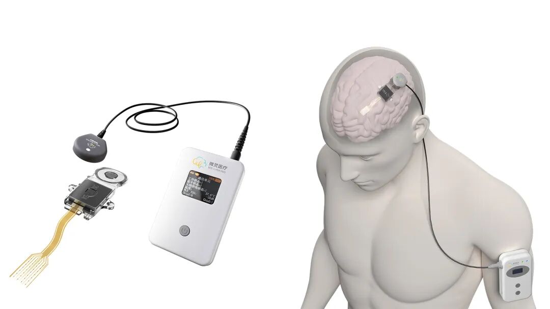 与巨头同轨竞速，微灵医疗以数倍临床数据，验证脑机接口的&ldquo;中国路径&rdquo;图7