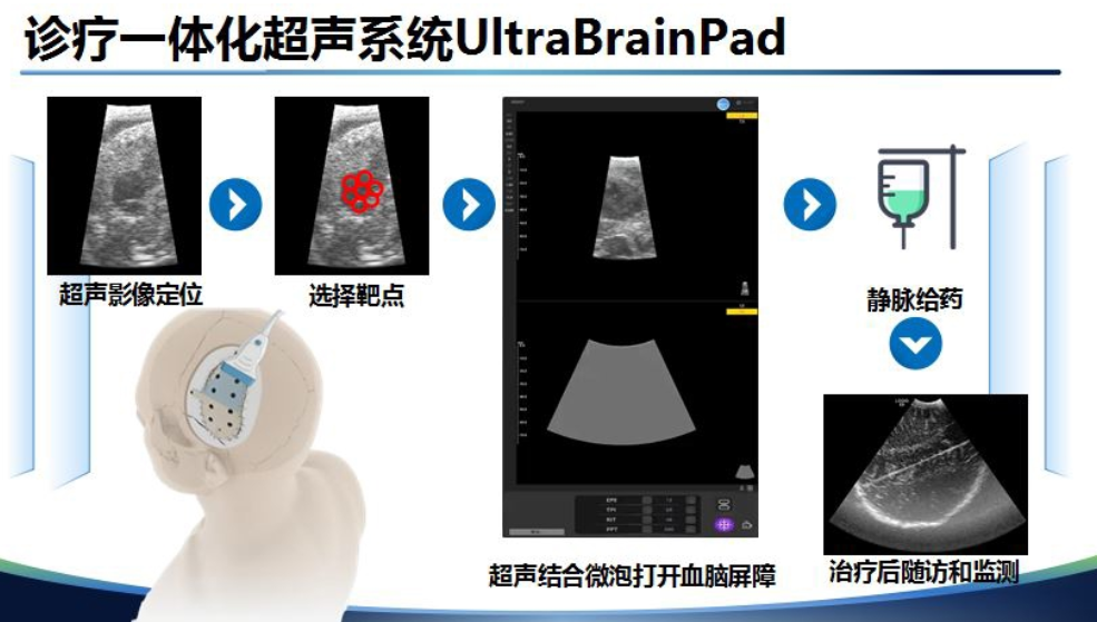 行业资讯 | 超声脑机接口来了！华山医院开启国内首例，将覆盖阿尔兹海默病等更多脑病图3