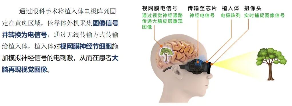 医疗 | 浙江省人民医院/杭州市第一人民医院植入式脑机接口临床招募、唐都医院完成西部首例北脑一号植入并招募患者等图6