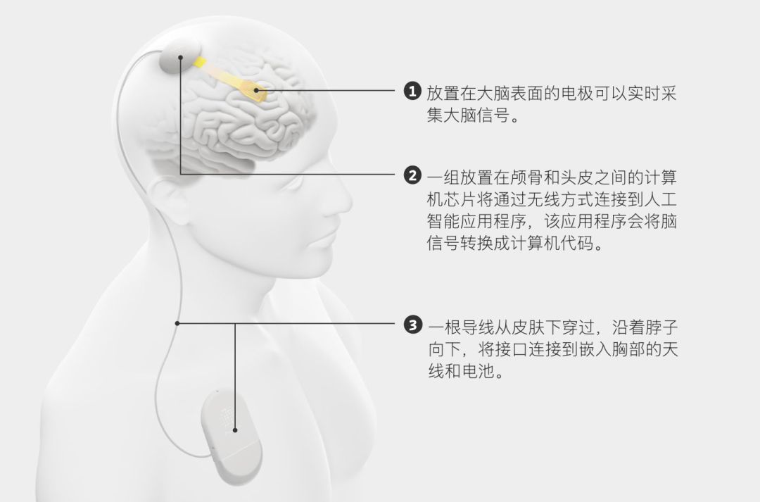 Precision 公布最新临床研究：不刺入脑组织，也能用意念操控电脑图2