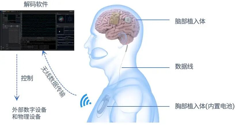 脑虎科技“三全”脑机接口系统进入国家药监局创新医疗器械特别审查程序图2