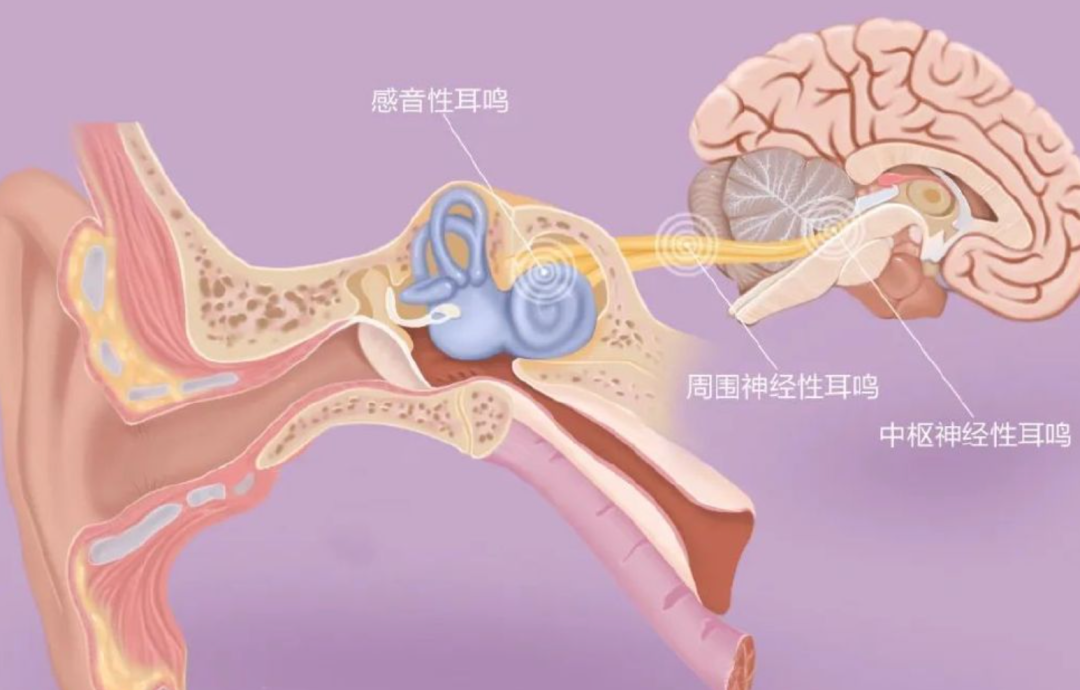 听觉脑机接口，这家公司已破解神经性耳鸣的关键密码图5